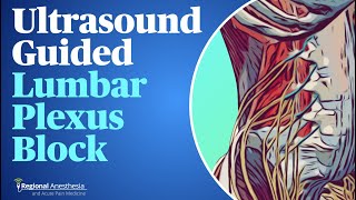 UltrasoundGuided Lumbar Plexus Block [upl. by Leirud]