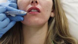 Juvederm lip filler injection by Dr Shaun Patel in Miami Florida [upl. by Greenwell]