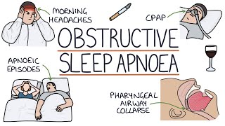 Obstructive Sleep Apnoea [upl. by Eseerehc]