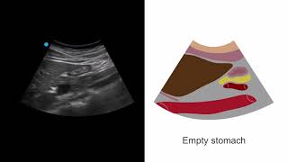 Gastric ultrasound for preoperative assessment [upl. by Strang]