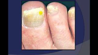 Toenail Debridement by a Podiatrist [upl. by Ecirtael]