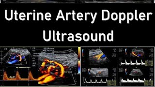 Uterine Artery Doppler Ultrasound Interpretation  Doppler Ultrasound in Fetal Growth Assessment [upl. by Marielle]