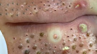 Big Cystic Acne Blackheads Extraction Blackheads amp Milia Whiteheads Removal Pimple Popping  703 [upl. by Hurwit379]