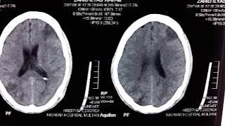 Space Occupying Lesion Brain SOL Brain [upl. by Lemar634]