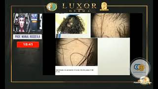 Basic Trichoscopy by Dr Manal Bosseila [upl. by Cresida]