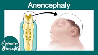 Anencephaly  Neural tube defects  folate deficiency  USMLE [upl. by Shepperd925]