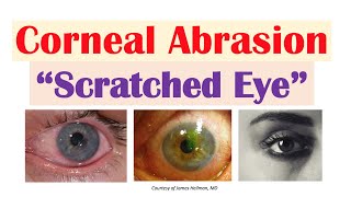 Corneal Abrasion “Scratched Eye”  Causes Signs amp Symptoms Diagnosis Treatment [upl. by Nelo429]