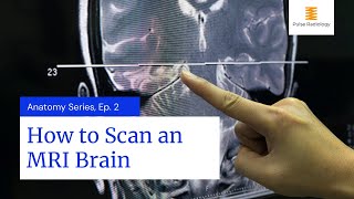 How to Scan an MRI Brain [upl. by Hwu]