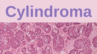 Cylindroma  Pathology mini tutorials [upl. by Yelhak]