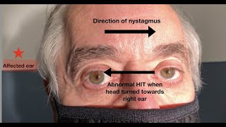 What ear does the nystagmus in vestibular neuritis beat towards [upl. by Michael230]