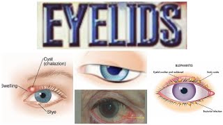 Eyelids 6 Major Topic Entropion [upl. by Harriett]