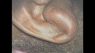 Treatment of Auricular Hematoma [upl. by Lesslie726]