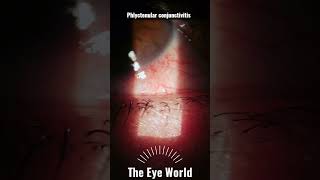 phlyctenular conjunctivitis [upl. by Yelrahs]