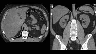 Adrenal adenomas on CT  a diagnostic approach [upl. by Annoyik]