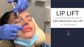 Lip Filler Lip Lift with the Russian Technique [upl. by Harimas85]