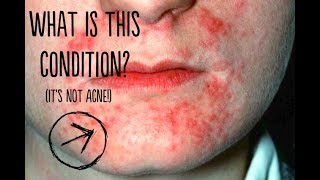 What Is This Skin Condition amp How Do You Treat It [upl. by Retseh]