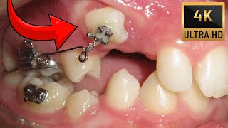 🔥Unexpected orthodontic impaction🔥Timelapse of BRACES in 4K [upl. by Mahtal]