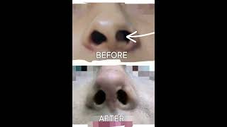 What is a Deviated Nasal Septum facequation nepalidoctor septoplasty rhinoplasty [upl. by Atalaya811]