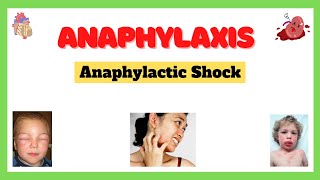 Anaphylactic Shock Anaphylaxis Signs and Symptoms Causes Complications Treatment Made Easy [upl. by Gradey430]