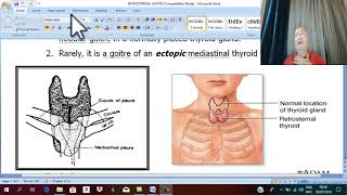 Thyroid Disorders in English 9 Retrosternal Goiter   by Dr wahdan [upl. by Eissim892]