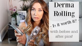 Derma Roller Review with Before and After Pics [upl. by Leachim426]