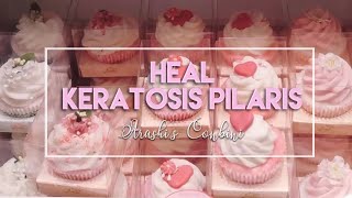 ♡ Heal Keratosis Pilaris ♡ [upl. by Ayaj811]