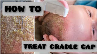 How to Treat Cradle CapNewborn baby newborn cradlecap [upl. by Assirt317]