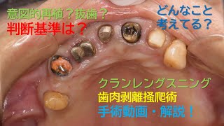 どうする縁下カリエス、慢性根尖性歯周炎、重度慢性歯周炎！？～歯槽骨切除術、クラウンレングスニング、フラップ手術、歯肉剥離掻爬術、抜歯編～ [upl. by Aisena]