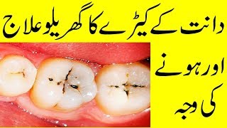 Dant ka Keera Khatam karna ka Tarika  Cavity Treatment at Home [upl. by Anigger]