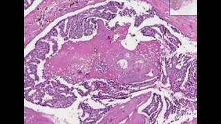 Histopathology BreastDuctal carcinoma in situ [upl. by Thisbe314]