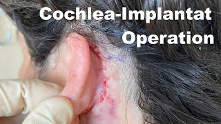 Cochlea Implantat die Operation Risiken amp Folgen [upl. by Collimore]