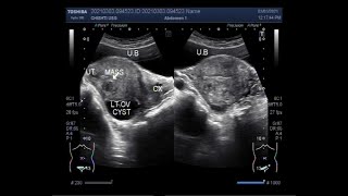 Multiple Fibroids with an Ovarian cyst [upl. by Rivi]