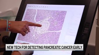 Detecting pancreatic cancer earlier than ever before [upl. by Desai]