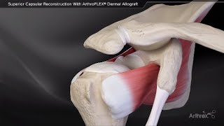 Superior Capsular Reconstruction With ArthroFLEX® Dermal Allograft [upl. by Oznohpla]