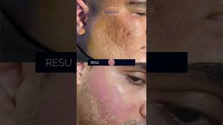 Dermabrasion  Noninvasive Procedure for Acne Scars  Dr Kamal [upl. by Hofmann833]