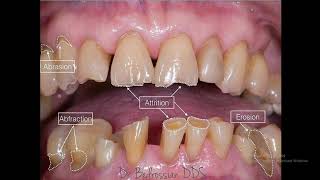 9Compare between attrition abrasion abfraction and erosionOSCE [upl. by Katuscha]