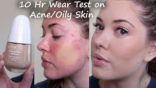 New Clinique Even Better Clinical Serum Foundation WEAR TEST on acne prone amp oily skin cn 08 linen [upl. by Deyes]