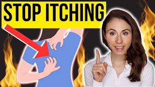 HOW TO STOP ITCHING ON THE BACK  Notalgia Paresthetica [upl. by Noirb139]