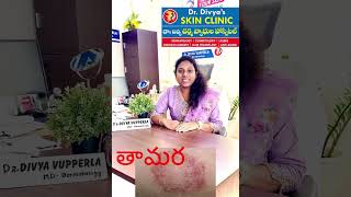 Skin fungus infectiontreatment tinea cruris divyaskinclinic drdivyavupperla Khammam khammam [upl. by Bak]