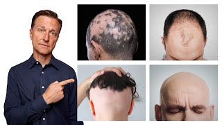 The 11 Types of Alopecia AND HOW TO FIX IT  Dr Berg [upl. by Aikehs]