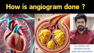 what is a coranary angiogram  how is it done  doctor adithacibi [upl. by Nnaegroeg]