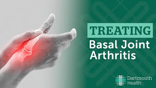 Basal Joint Arthritis [upl. by Ayra]