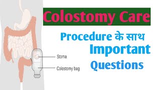 Colostomycare colostomy  Colostomy care [upl. by Novy]