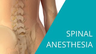 Spinal Anesthesia  The steps of spinal anesthesia [upl. by Stauder]