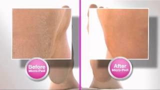 Emjoi MICRO Pedi TV Commercial August 2012 [upl. by Carlene]