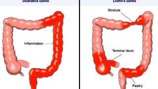 Crohn Disease [upl. by Absalom592]