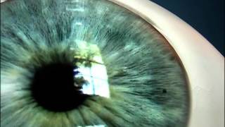 Laser Iridotomy for Angle Closure Glaucoma [upl. by Keifer132]