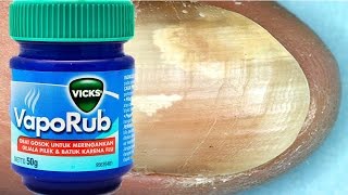 Toenail Fungus Treatment The Right Way to Treat TOE NAIL FUNGUS with Vicks VapoRub [upl. by Hewitt]