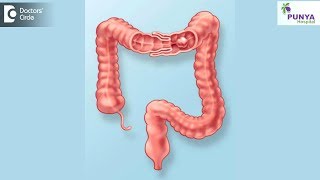 What is the treatment for Intussusception  Dr Nagaraj B Puttaswamy [upl. by Aromas]