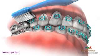 Life with Braces  Brushing amp Flossing [upl. by Bartosch718]